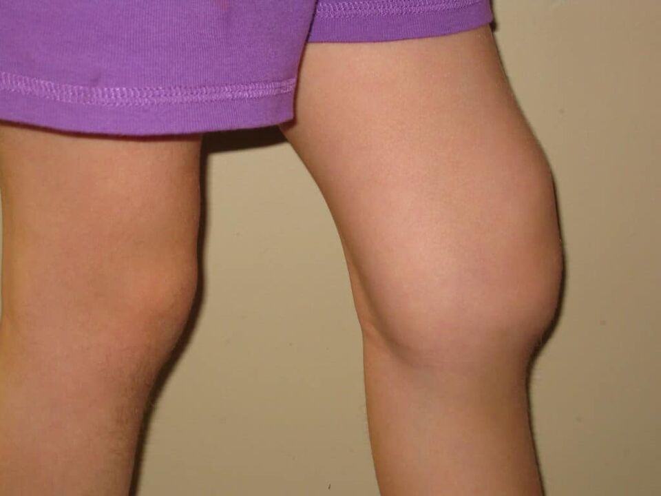 Patológia kolena s pokročilou artrózou