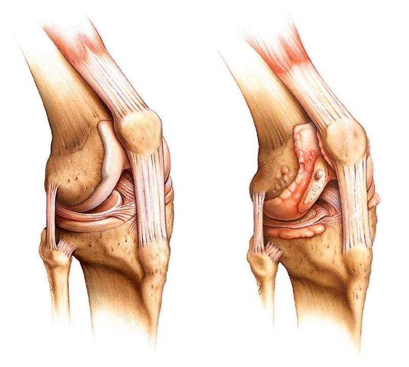 Zdravý kĺb (vľavo) a artritický kĺb (vpravo)