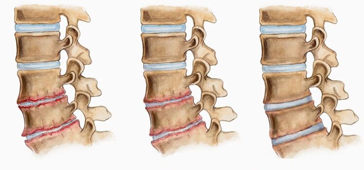 Deformácia medzistavcových platničiek pri osteochondróze môže spôsobiť bolesť chrbta