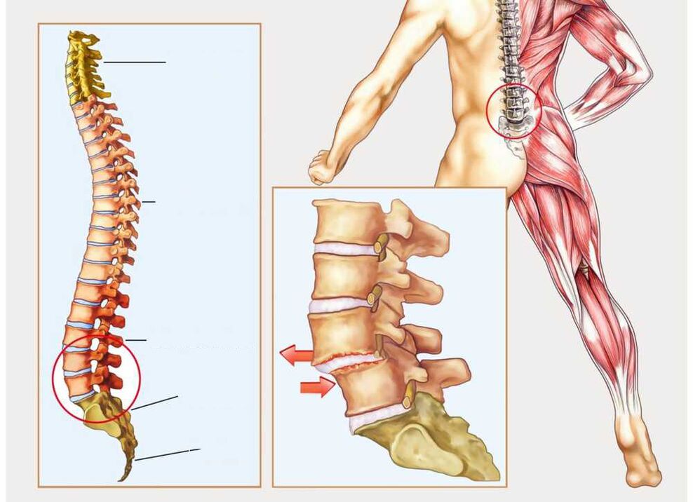 zdravú a chorú chrbticu