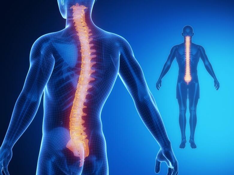 Osteochondróza chrbtice vyžadujúca komplexnú liečbu