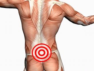 Osteochondróza bedrovej chrbtice