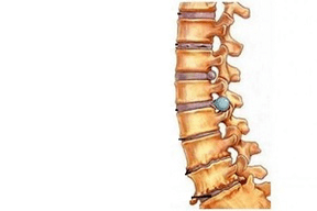 zmeny v chrbtici v rôznych štádiách vývoja cervikálnej osteochondrózy