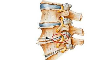zovretý disk chrbtice ako príčina cervikálnej osteochondrózy